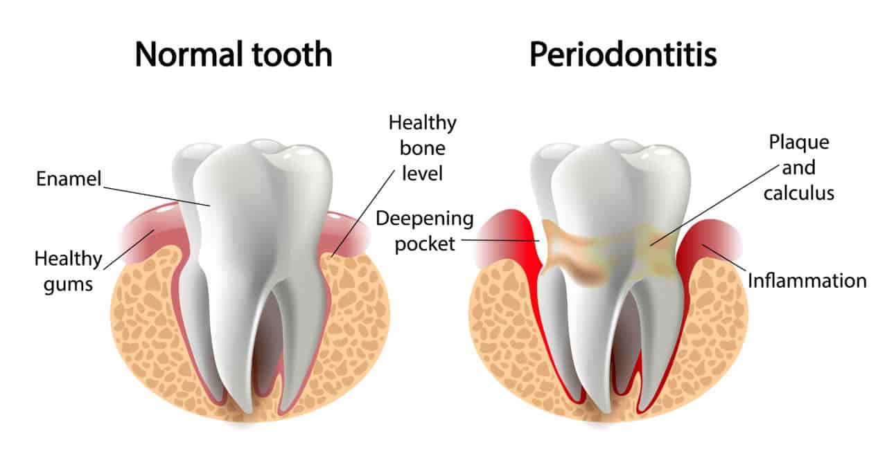 gum disease illustration